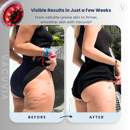 Vacuvia® SculptGlow™ – Firmer, More Toned Skin